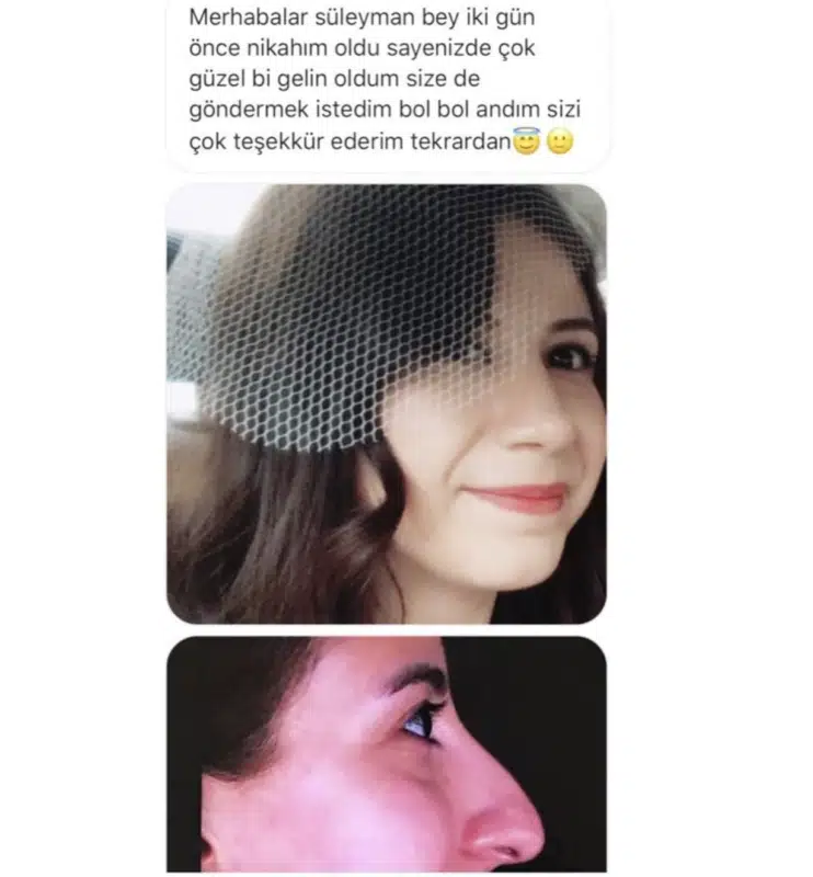 Suleyman Tas reviews – verified rhinoplasty patient review #226