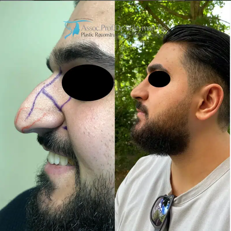 Suleyman Tas reviews – verified rhinoplasty patient review #170 (photo 3)