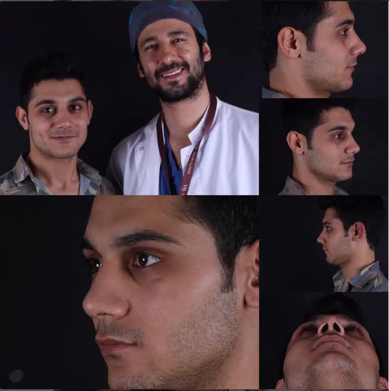 Suleyman Tas reviews – verified rhinoplasty patient review #337