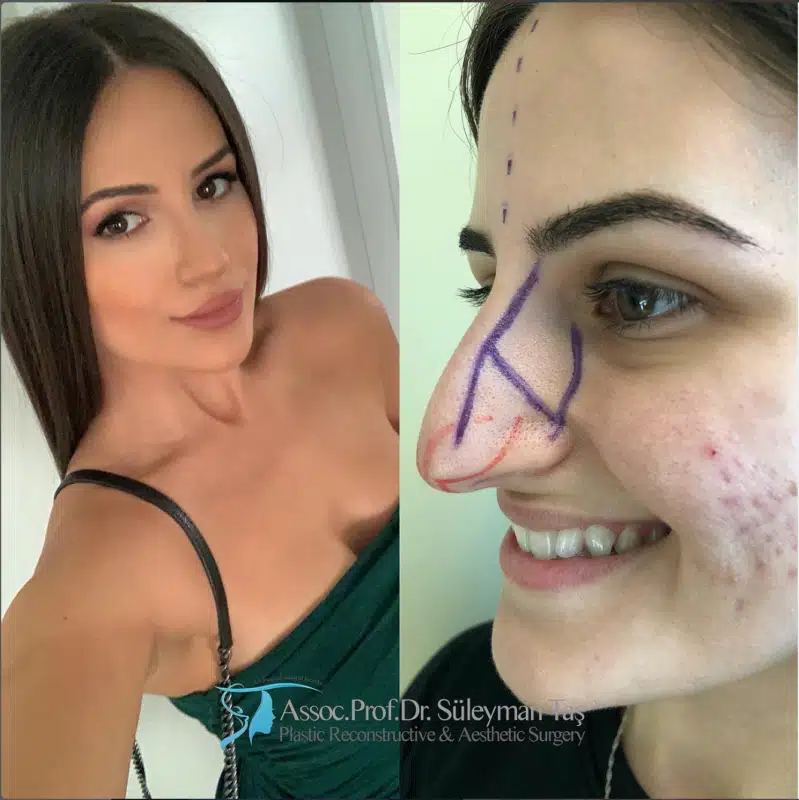 Suleyman Tas reviews – verified rhinoplasty patient review #188