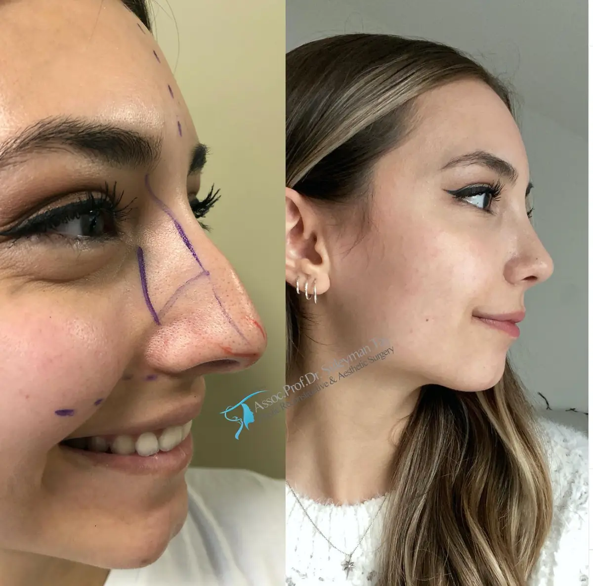 Suleyman Tas reviews – verified rhinoplasty patient review #154 (photo 2)
