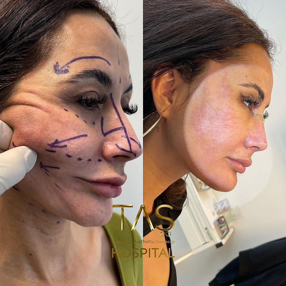 Woman before and 7 days after rhinoplasty, scarless facelift, neck lift, temporal lift, nano fat grafting and laser in one session by Prof. Dr. Suleyman Tas