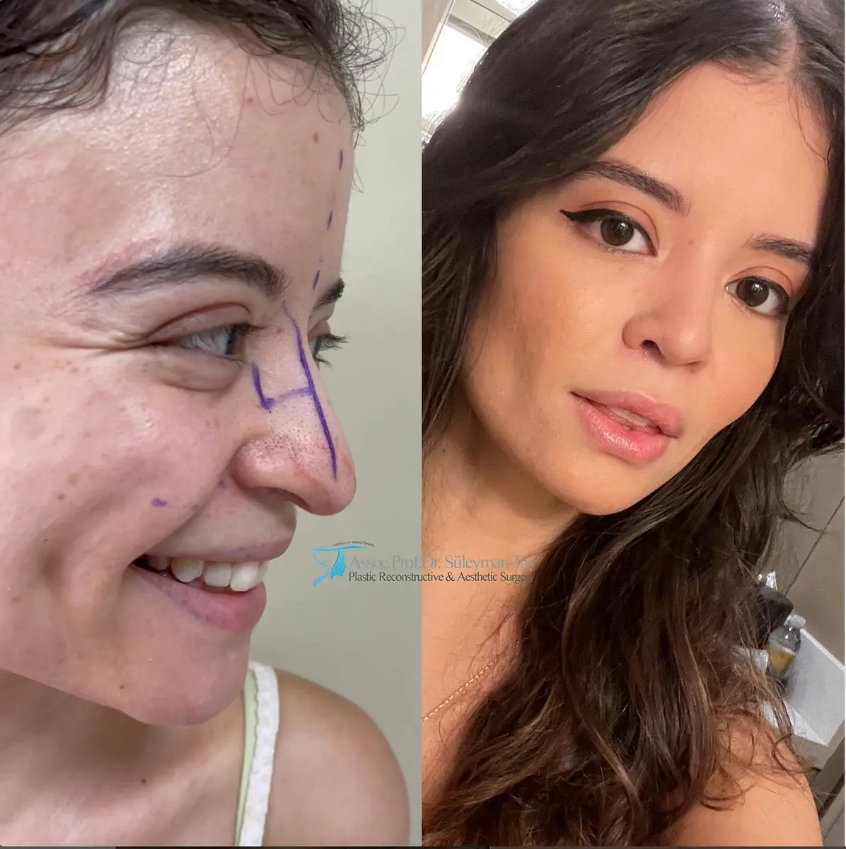 Suleyman Tas reviews – verified rhinoplasty patient review #114 (photo 2)