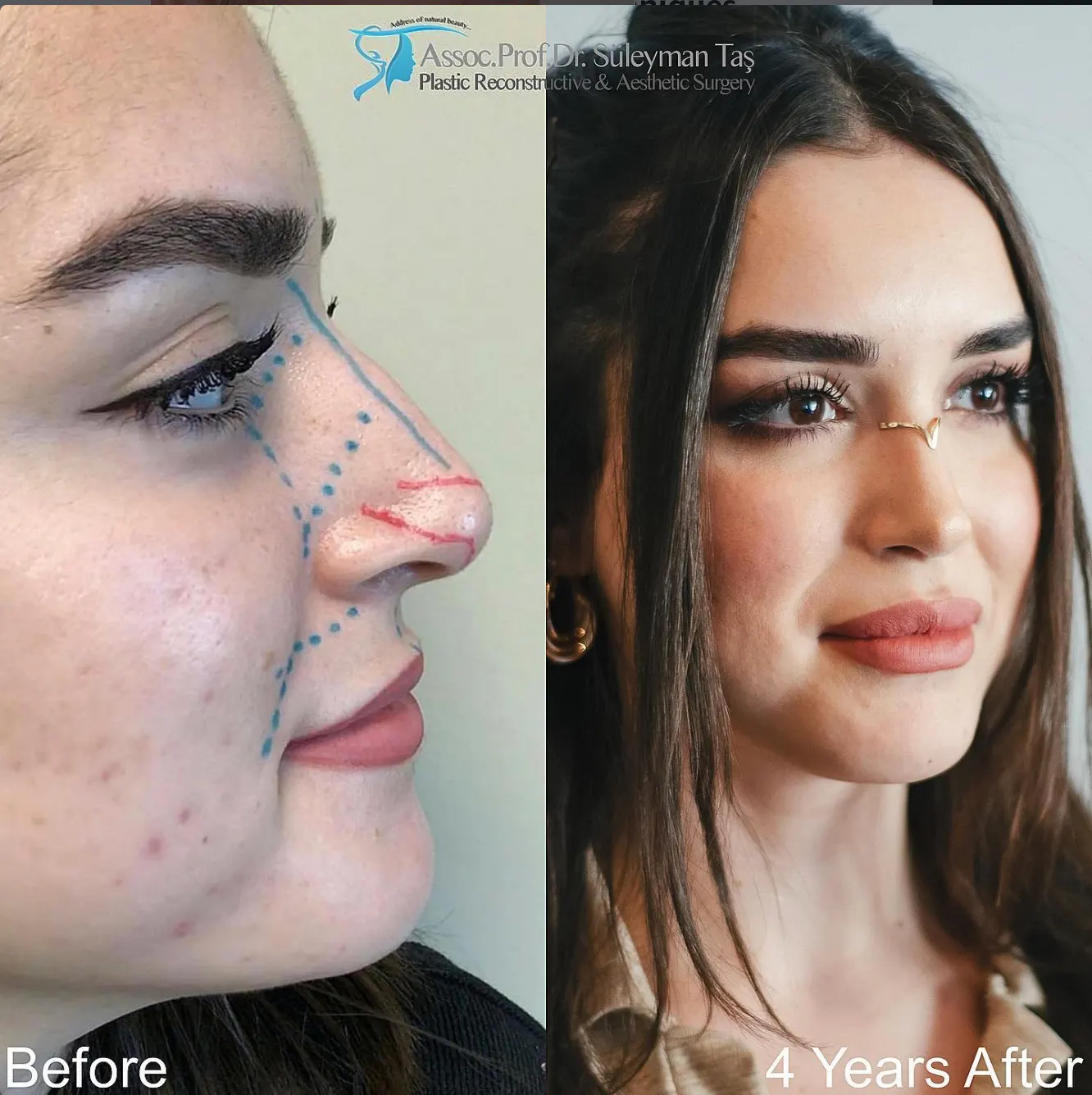 Suleyman Tas reviews – verified rhinoplasty patient review #73 (photo 2)