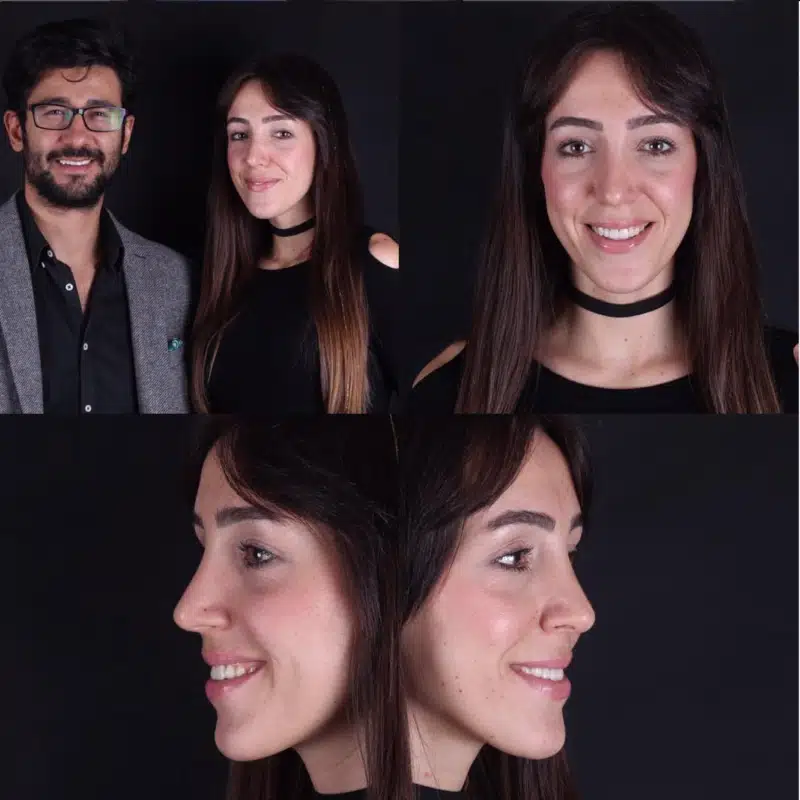 Suleyman Tas reviews – verified rhinoplasty patient review #274