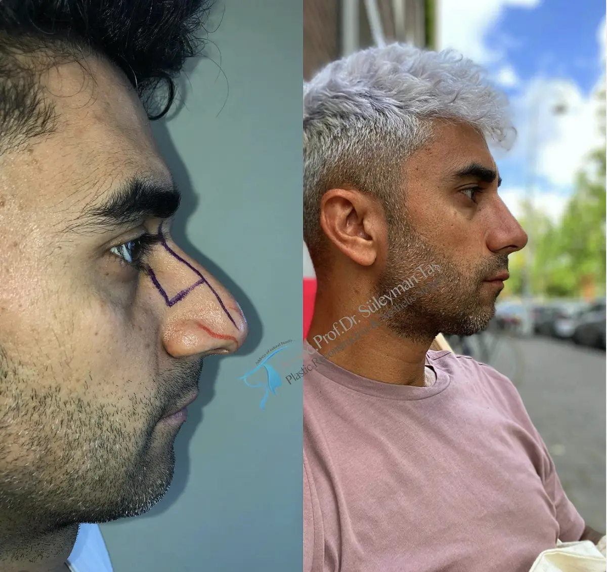 Suleyman Tas reviews – verified rhinoplasty patient review #166
