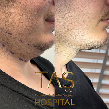 Neck Liposuction before and after photo of a male patient, side profile view, 7 days after surgery, by Prof. Dr. Süleyman Taş, plastic surgeon in Istanbul