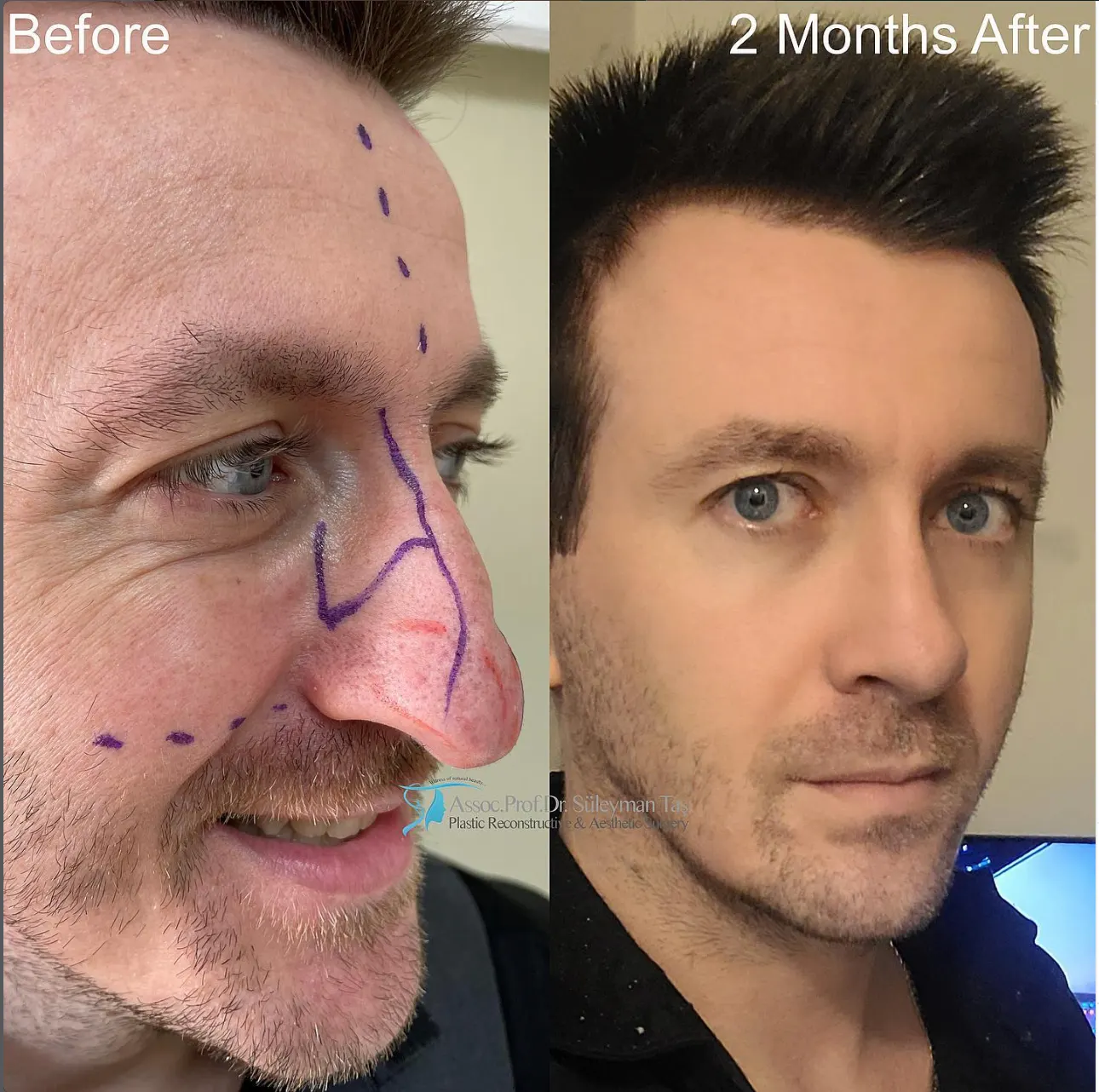 Suleyman Tas reviews – verified rhinoplasty patient review #90 (photo 1)