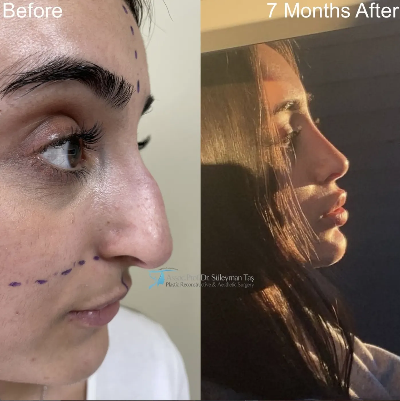 Suleyman Tas reviews – verified rhinoplasty patient review #66