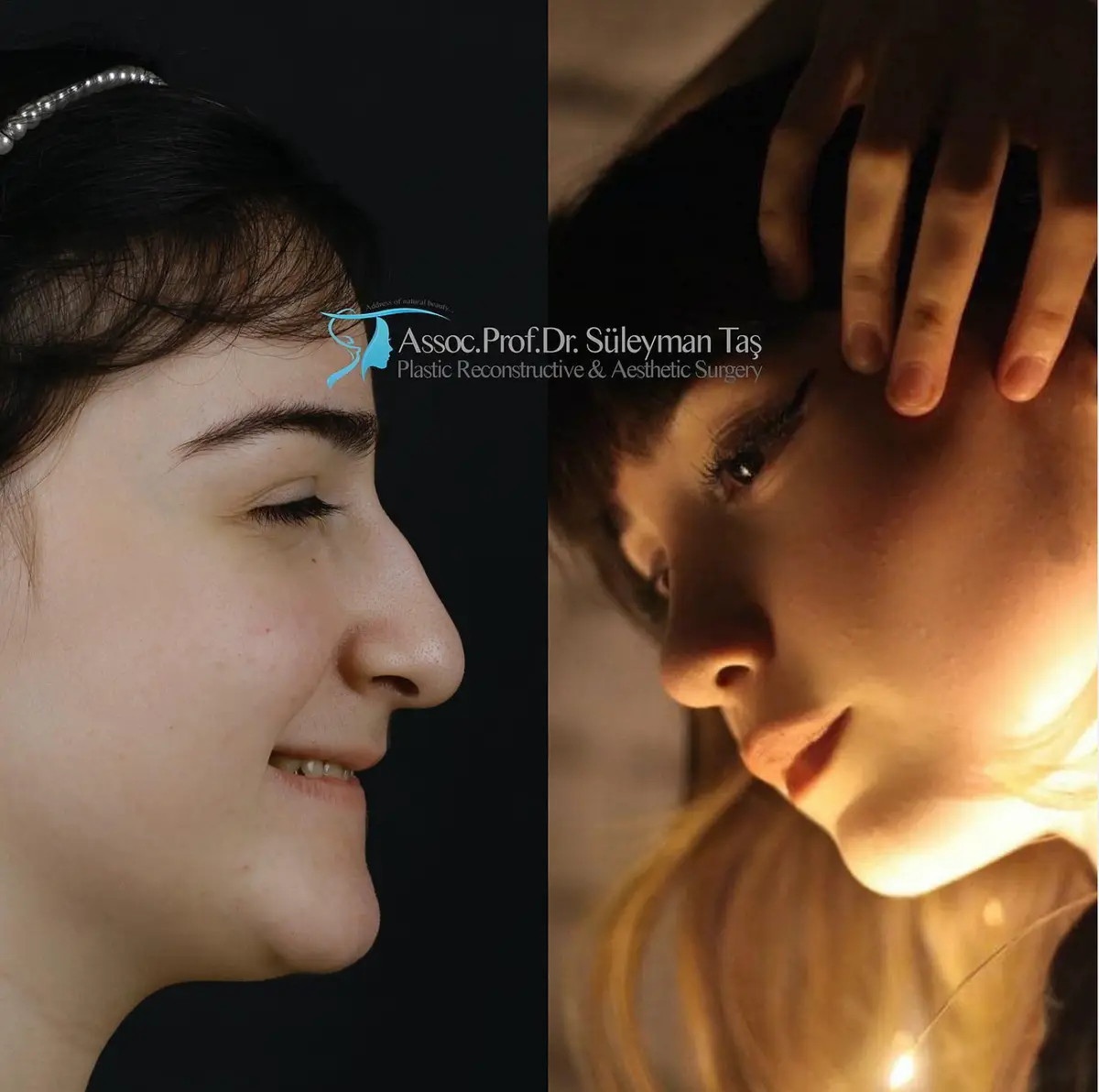 Suleyman Tas reviews – verified rhinoplasty patient review #152 (photo 1)