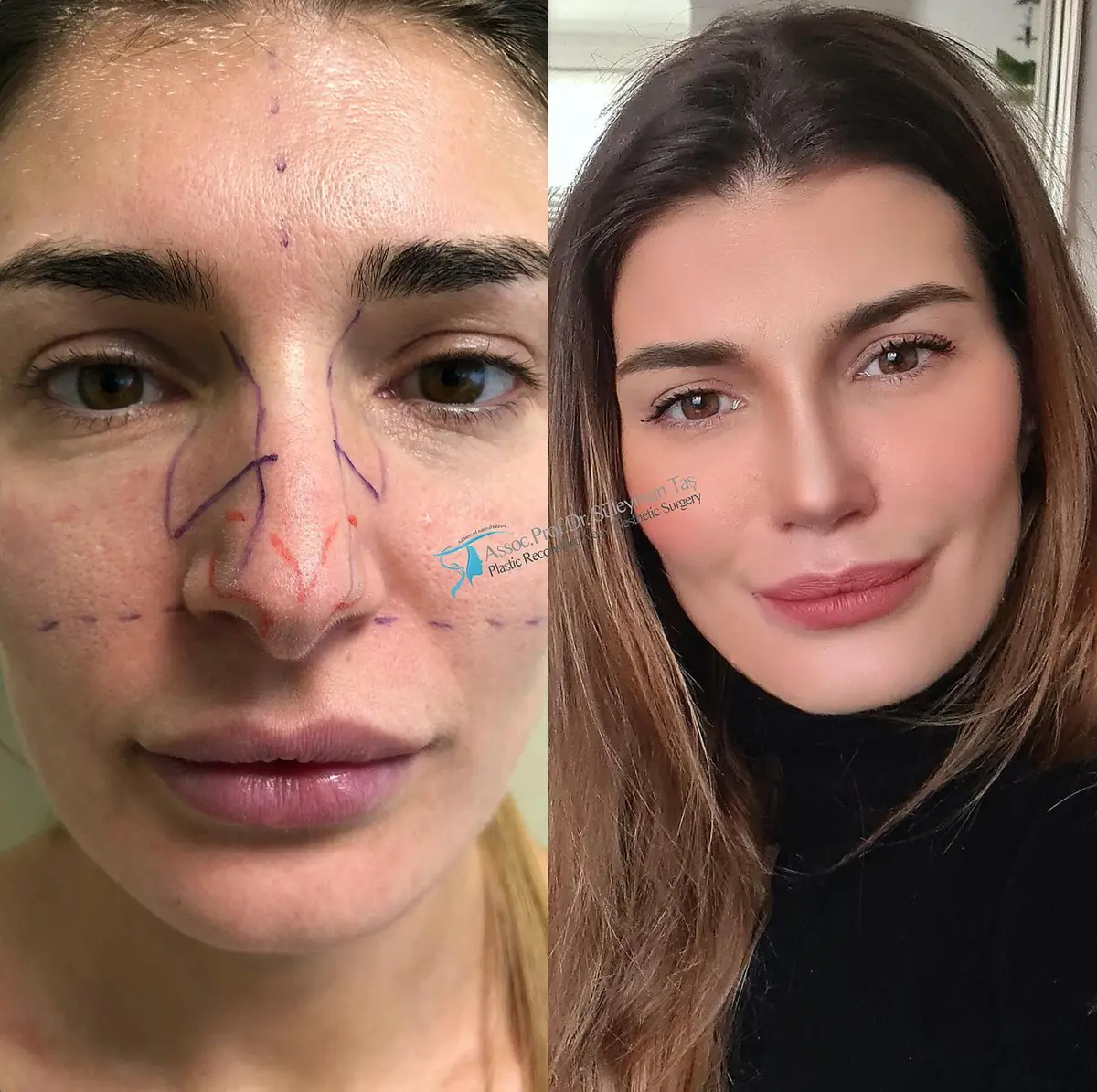Suleyman Tas reviews – verified rhinoplasty patient review #145 (photo 2)