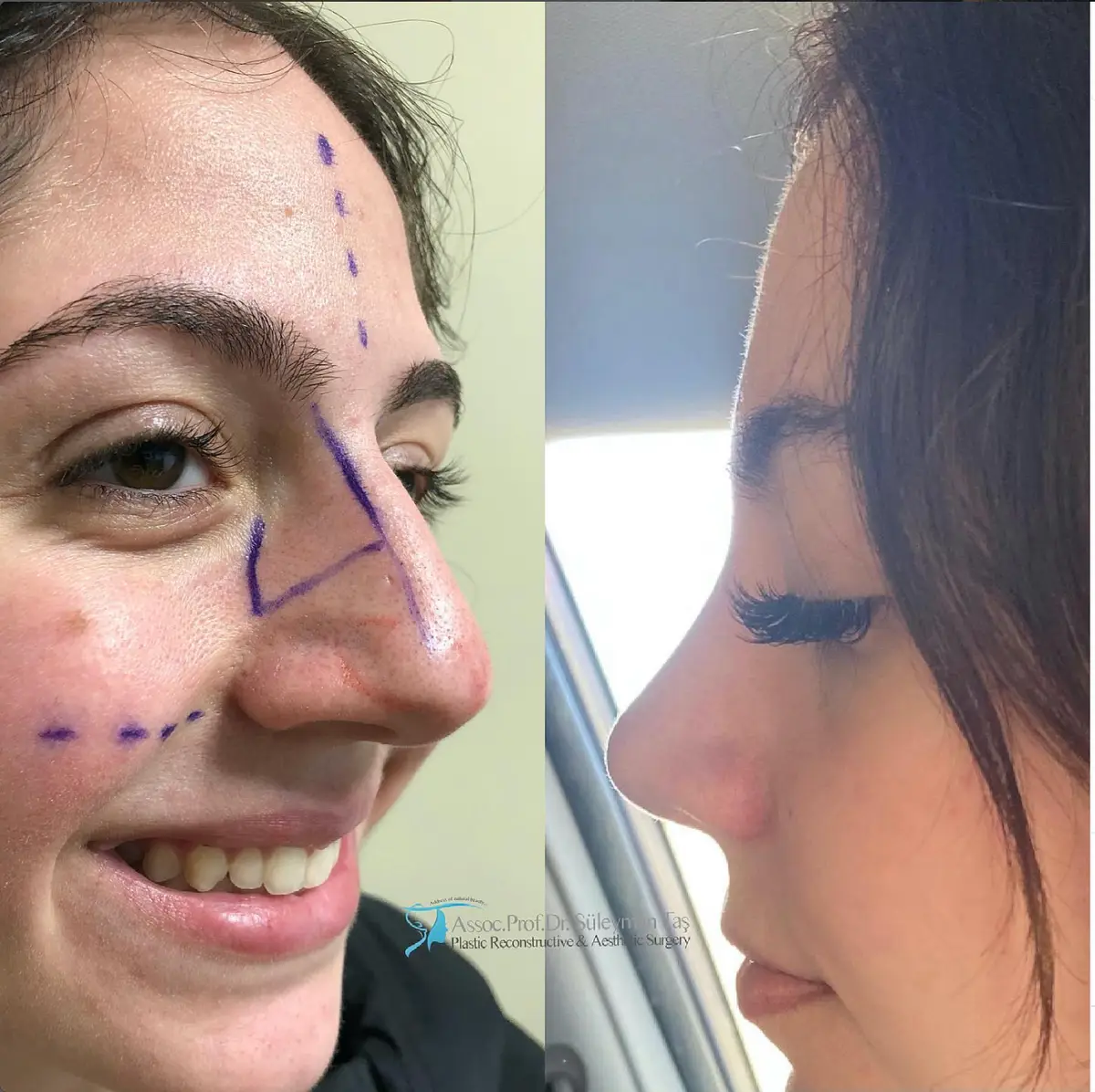 Suleyman Tas reviews – verified rhinoplasty patient review #133 (photo 2)