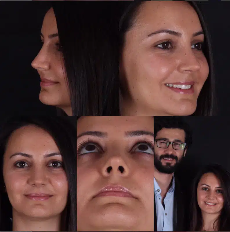 Suleyman Tas reviews – verified rhinoplasty patient review #245