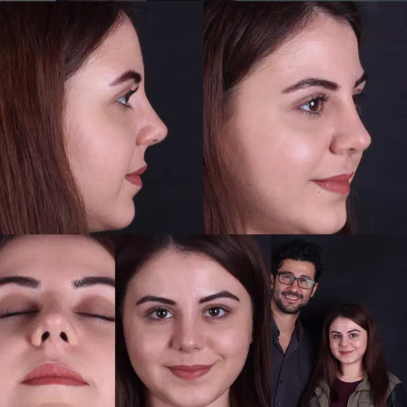 Suleyman Tas reviews – verified rhinoplasty patient review #279