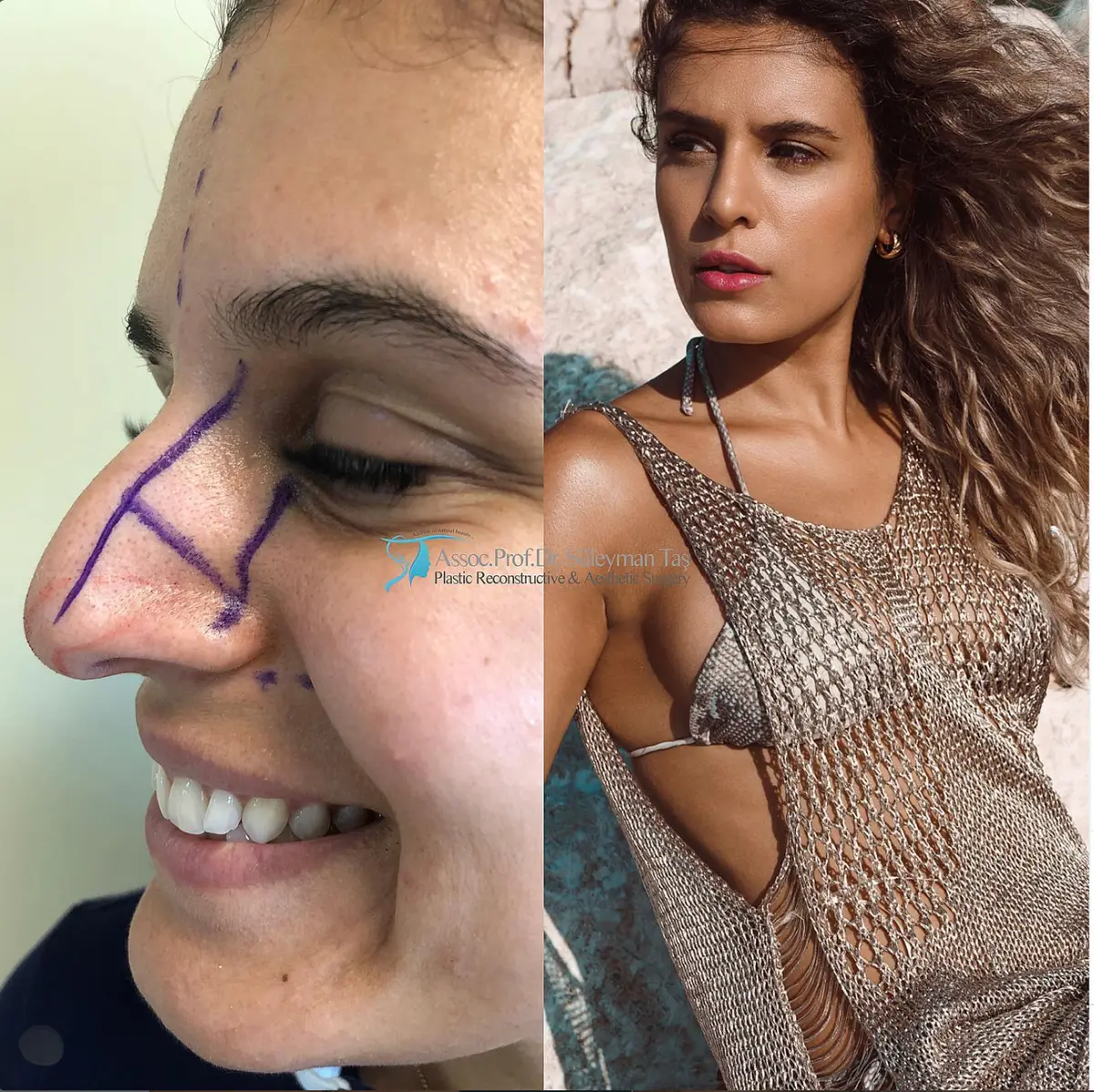 Suleyman Tas reviews – verified rhinoplasty patient review #118 (photo 1)