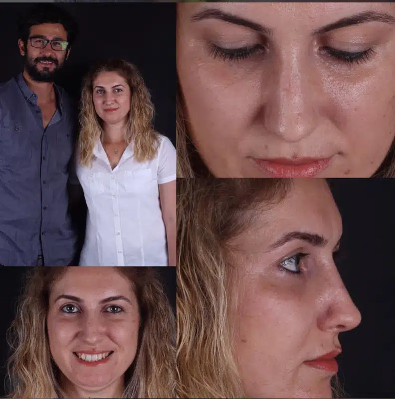 Suleyman Tas reviews – verified rhinoplasty patient review #305