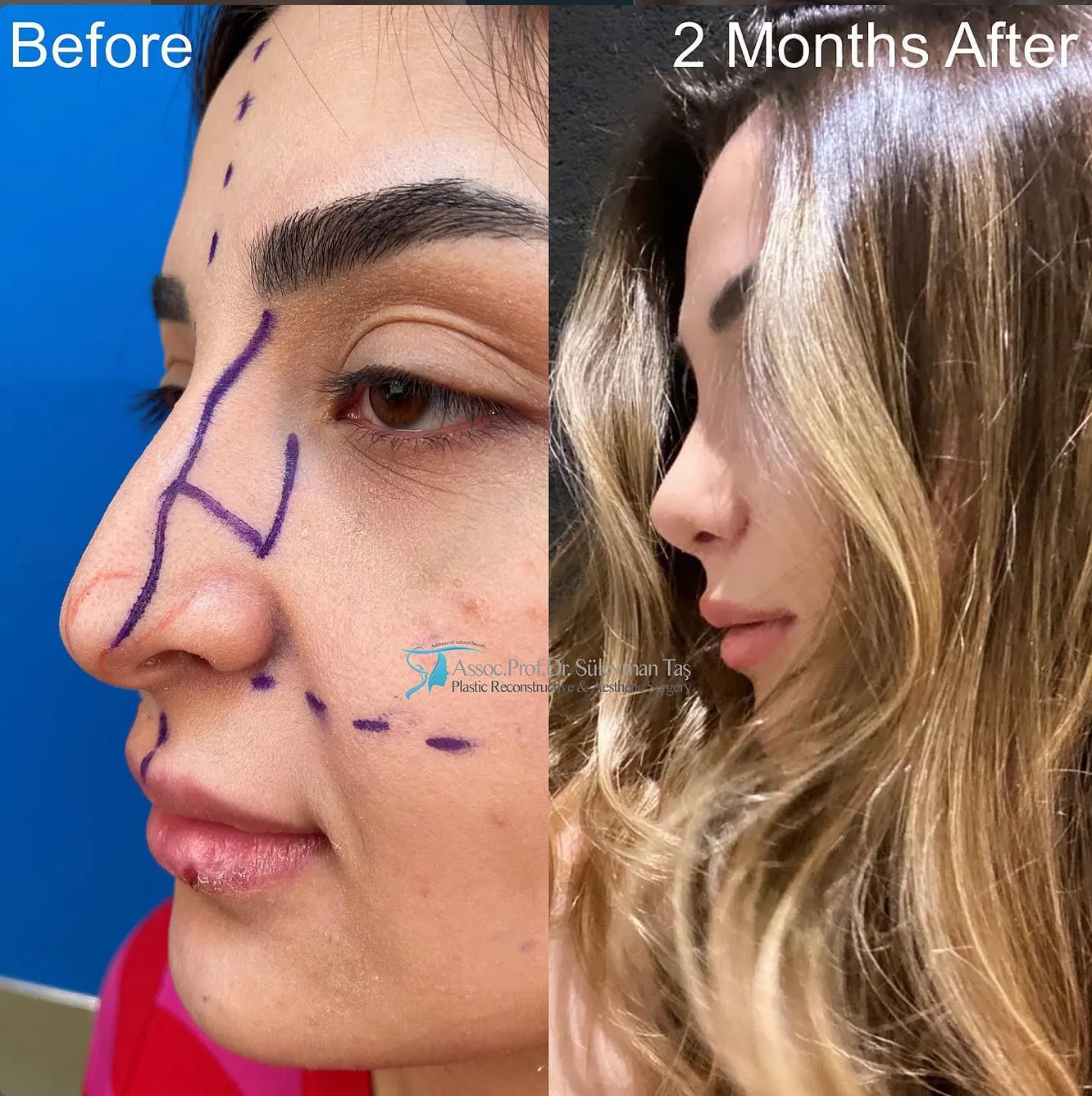 Suleyman Tas reviews – verified rhinoplasty patient review #63 (photo 2)