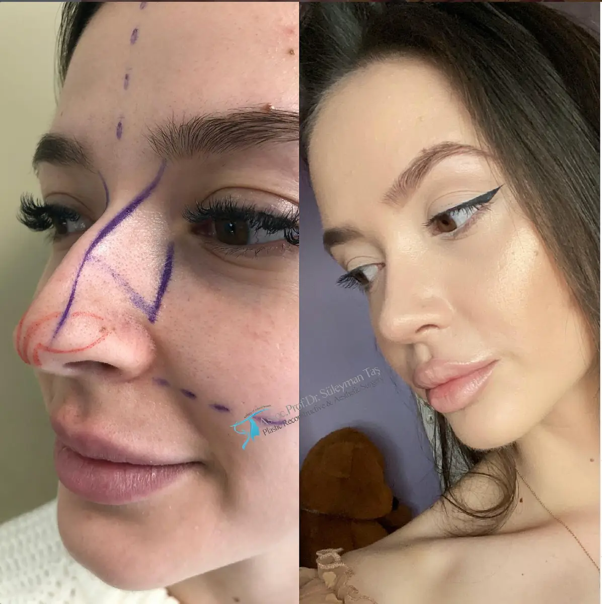 Suleyman Tas reviews – verified rhinoplasty patient review #132 (photo 2)