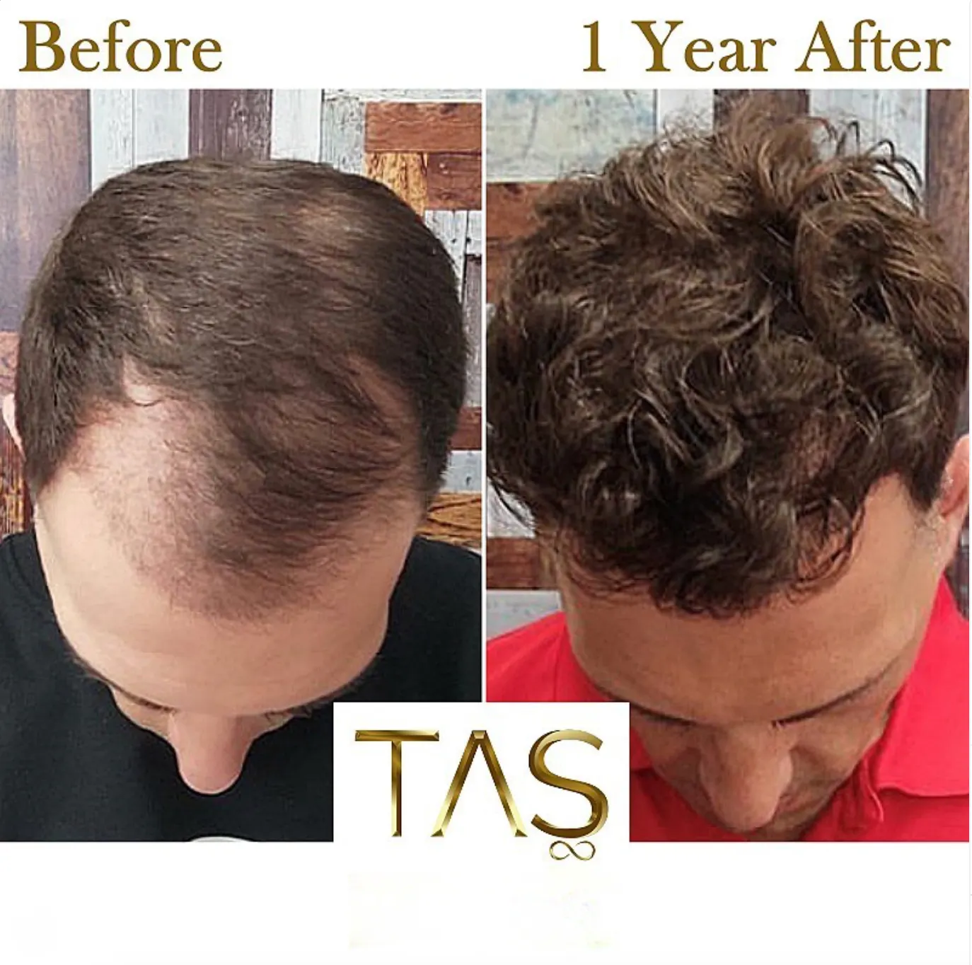 Suleyman Tas reviews – verified hair transplant patient review #50