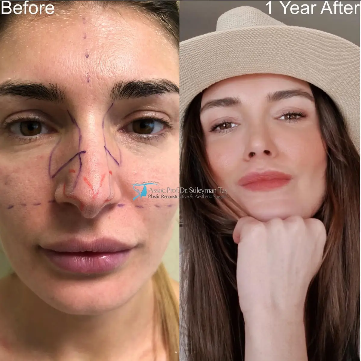 Suleyman Tas reviews – verified rhinoplasty patient review #97 (photo 1)
