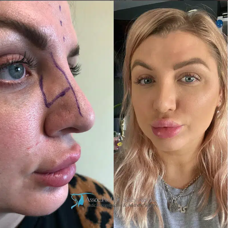 Suleyman Tas reviews – verified rhinoplasty patient review #178 (photo 2)