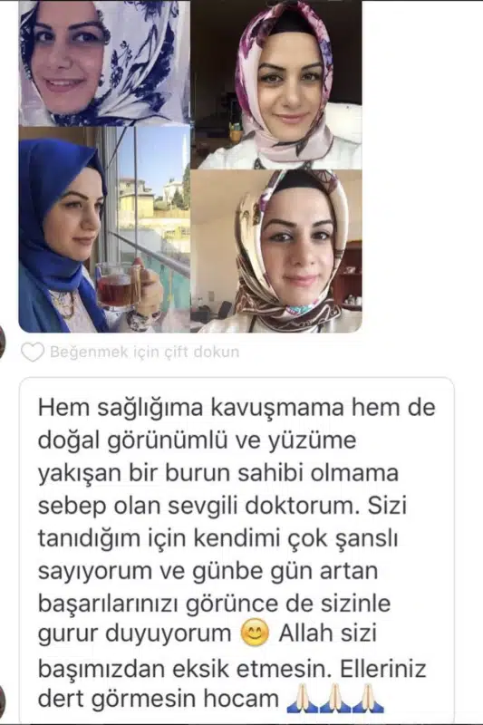 Suleyman Tas reviews – verified rhinoplasty patient review #340