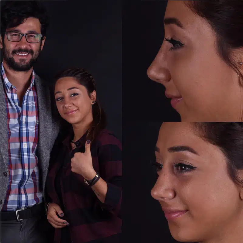 Suleyman Tas reviews – verified rhinoplasty patient review #286