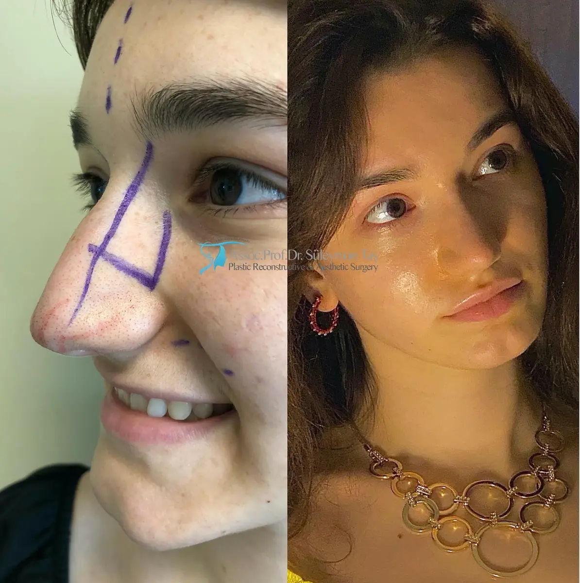 Suleyman Tas reviews – verified rhinoplasty patient review #153 (photo 2)