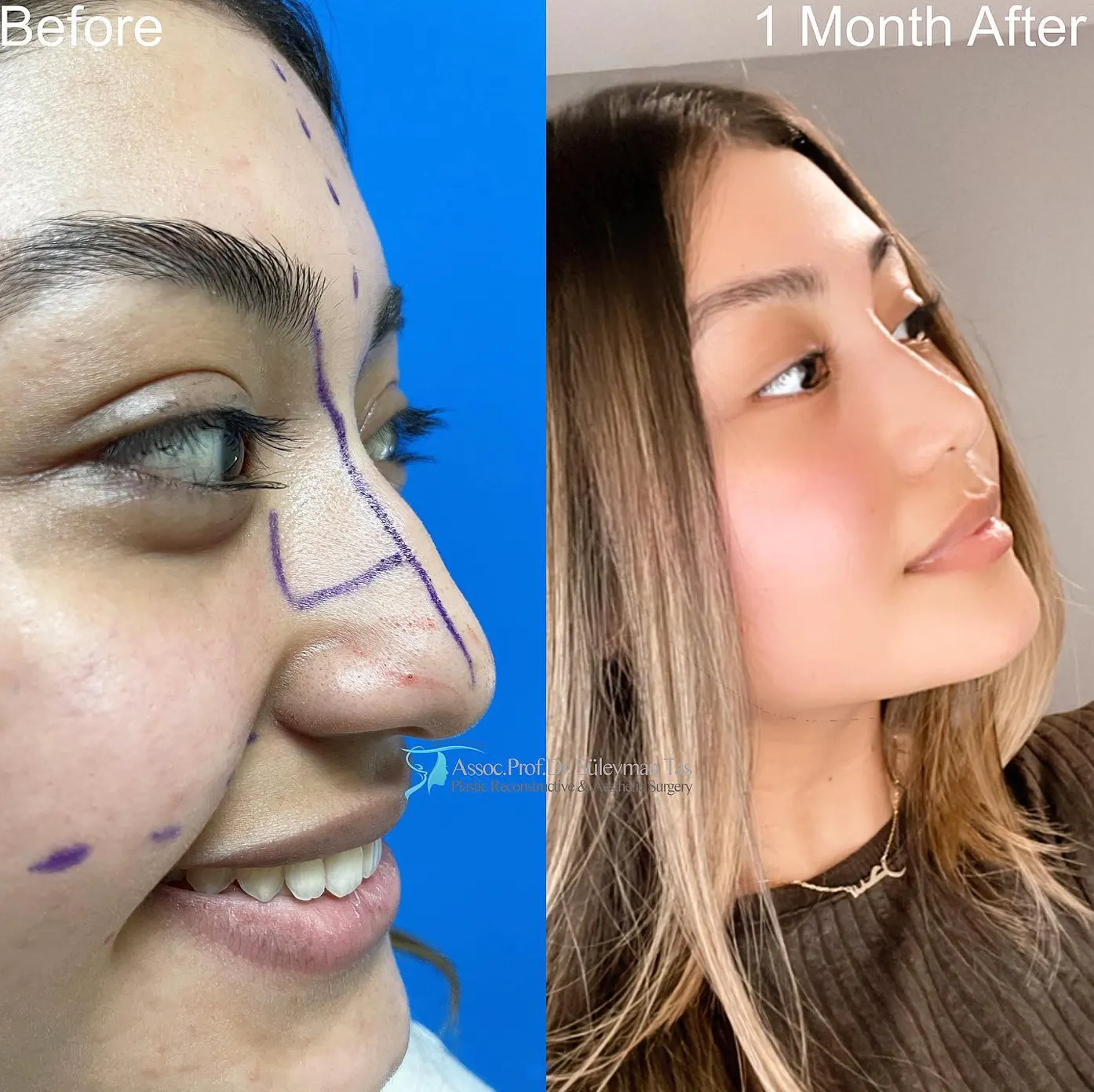 Suleyman Tas reviews – verified rhinoplasty patient review #77 (photo 2)