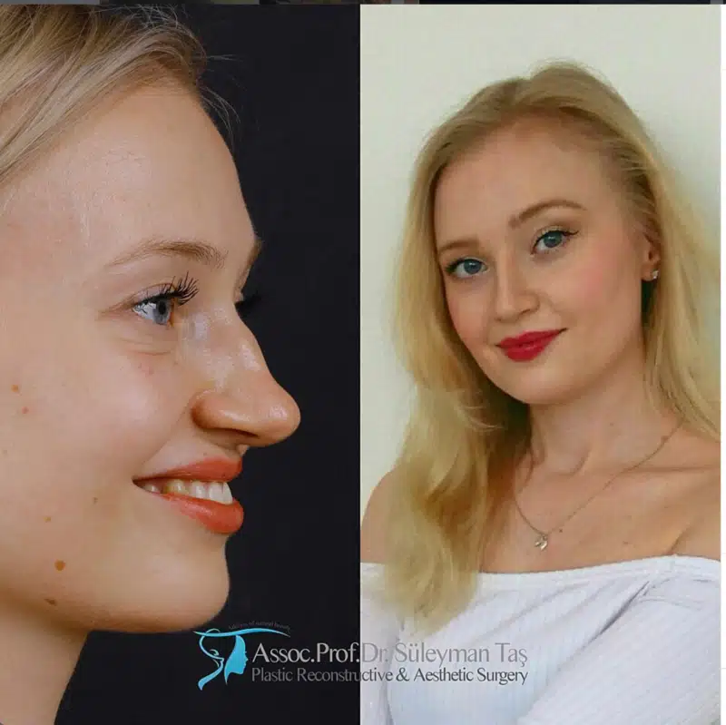 Suleyman Tas reviews – verified rhinoplasty patient review #180 (photo 1)