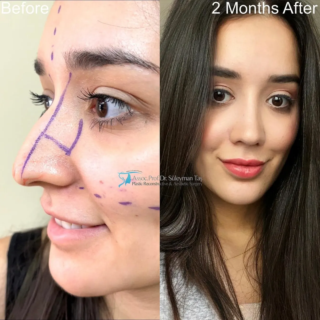 Suleyman Tas reviews – verified rhinoplasty patient review #91 (photo 2)