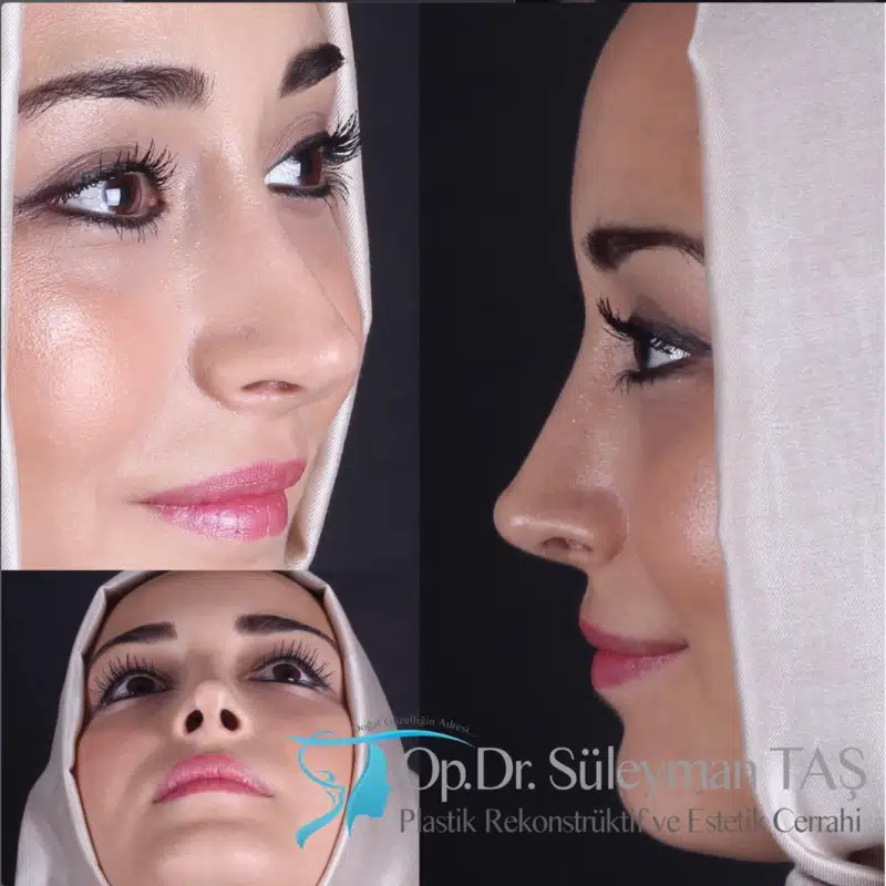 Suleyman Tas reviews – verified rhinoplasty patient review #276