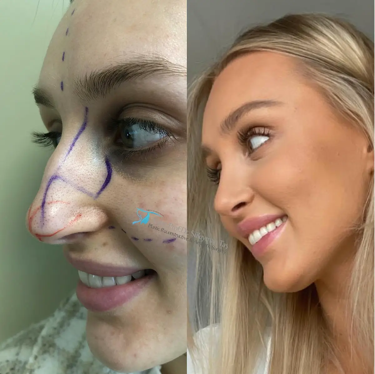 Suleyman Tas reviews – verified rhinoplasty patient review #134 (photo 1)