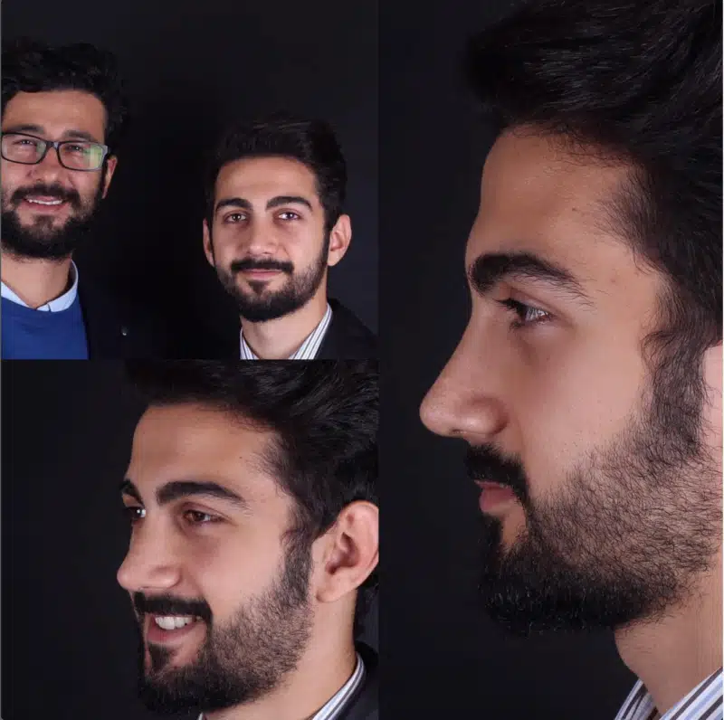 Suleyman Tas reviews – verified rhinoplasty patient review #282
