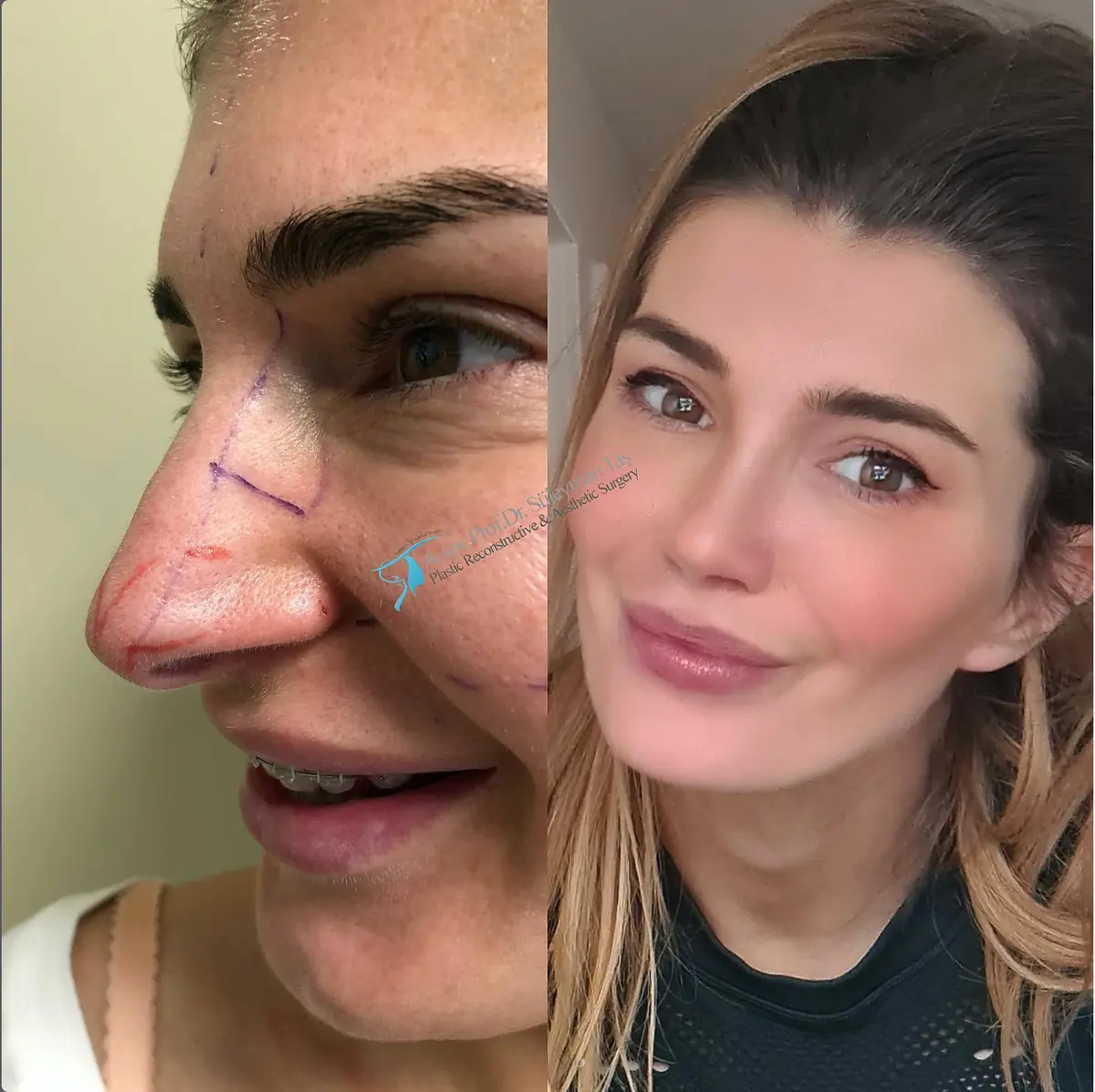 Suleyman Tas reviews – verified rhinoplasty patient review #145 (photo 1)