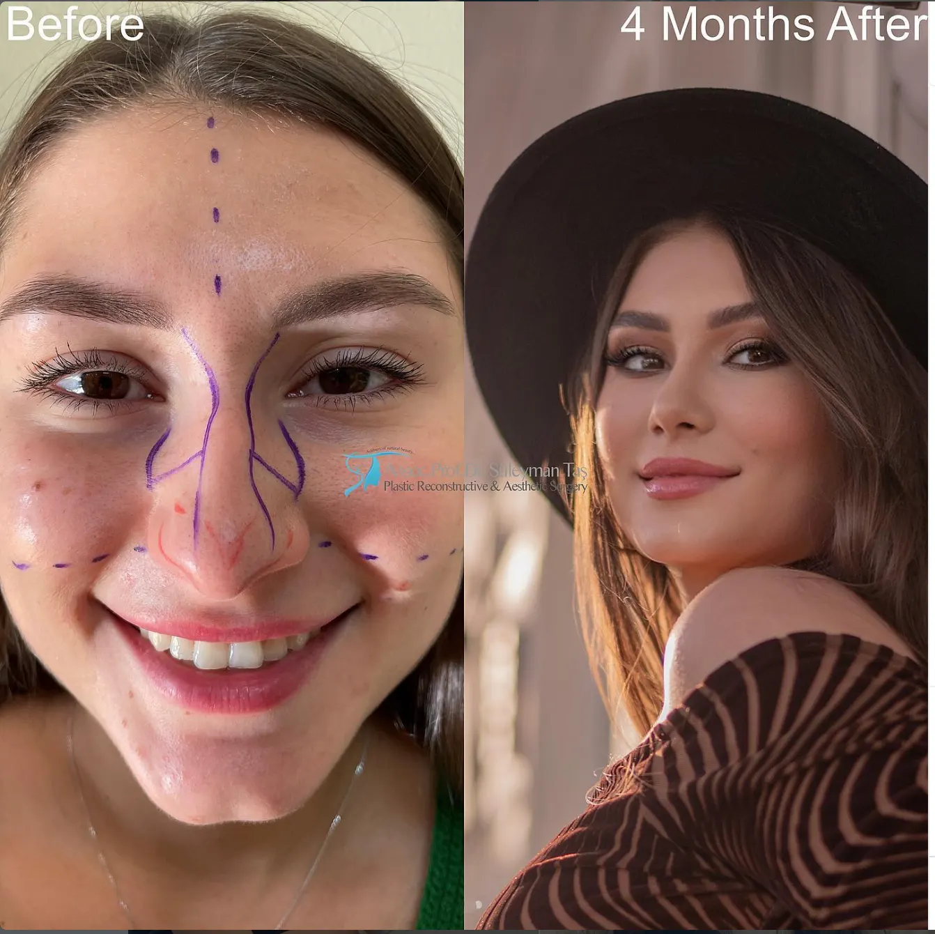 Suleyman Tas reviews – verified rhinoplasty patient review #81 (photo 1)