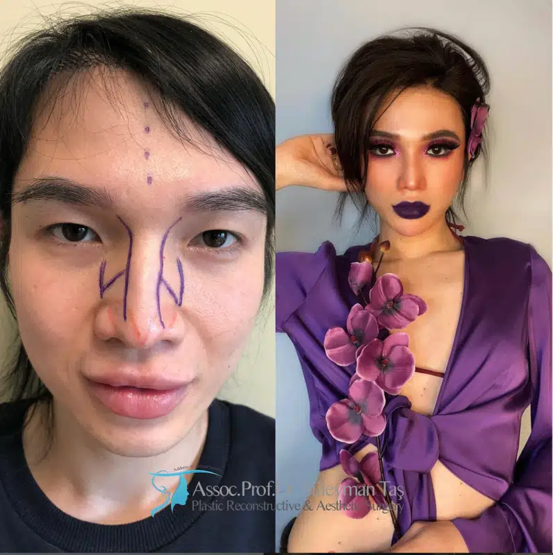 Suleyman Tas reviews – verified rhinoplasty patient review #185 (photo 1)
