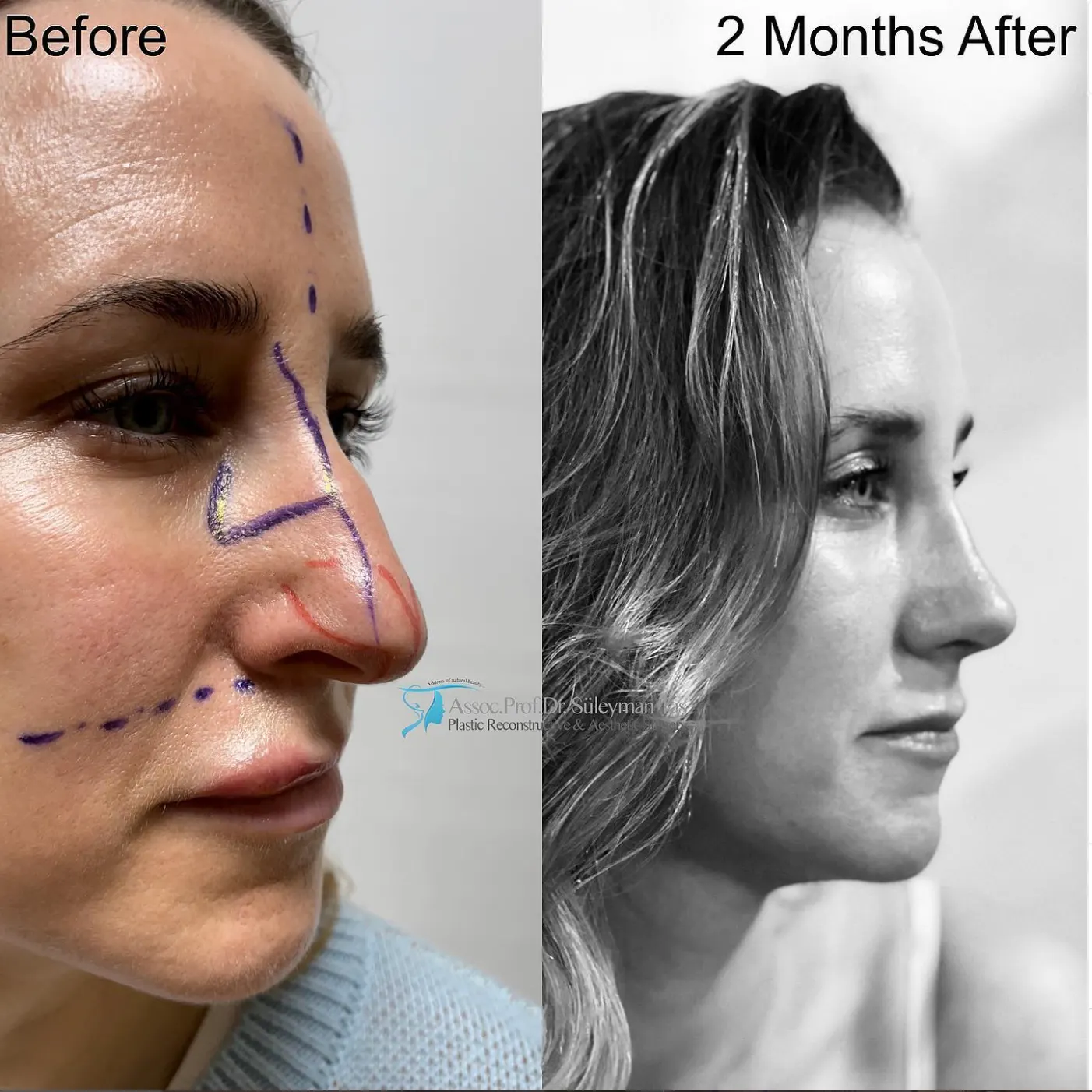 Suleyman Tas reviews – verified rhinoplasty patient review #61