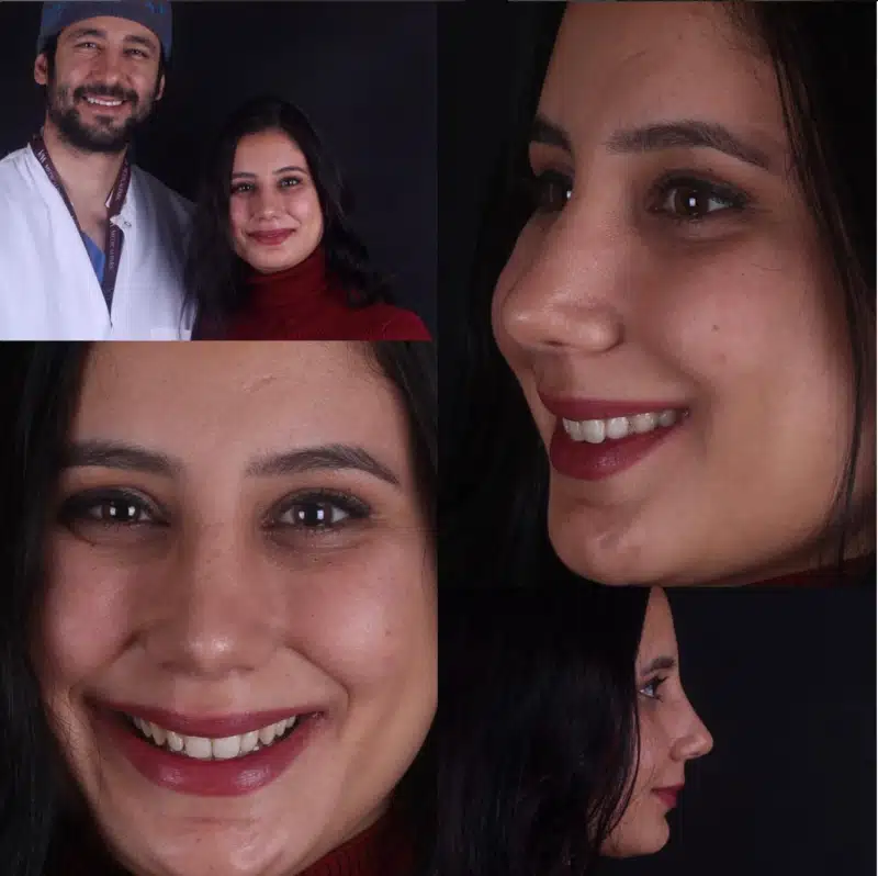 Suleyman Tas reviews – verified rhinoplasty patient review #335
