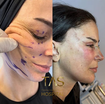 Scarless Facelift before and after photo of a female patient, live surgery comparison, 2 weeks after surgery, by Prof. Dr. Süleyman Taş, plastic surgeon in Istanbul