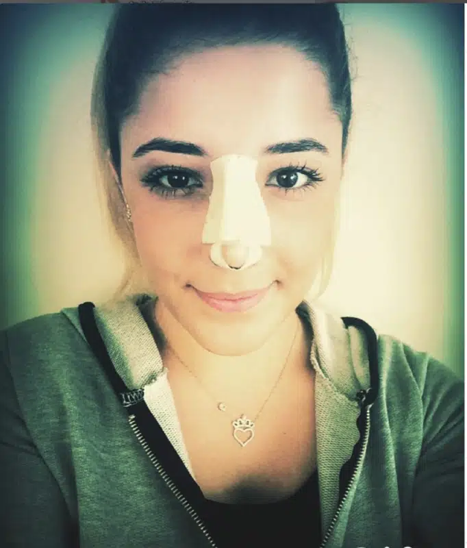 Suleyman Tas reviews – verified rhinoplasty patient review #390