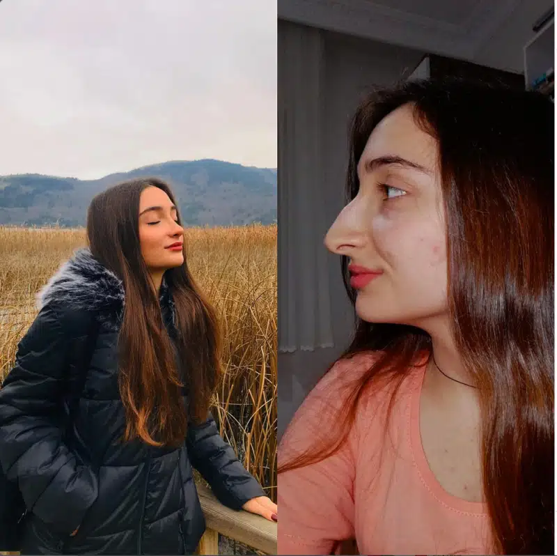 Suleyman Tas reviews – verified rhinoplasty patient review #179 (photo 2)