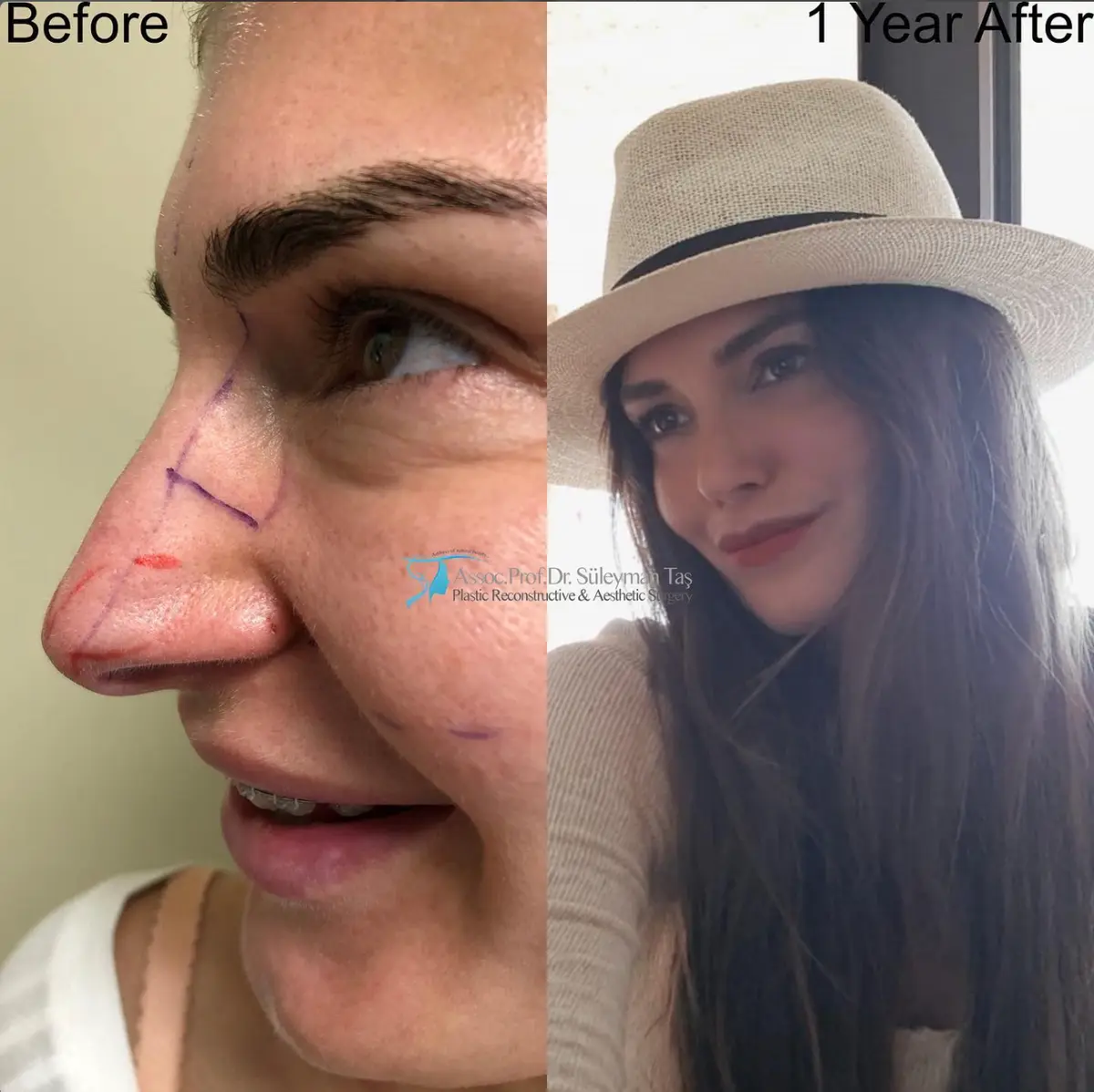 Suleyman Tas reviews – verified rhinoplasty patient review #97 (photo 2)