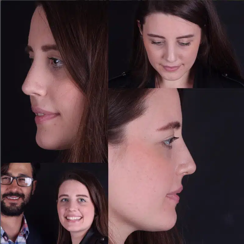 Suleyman Tas reviews – verified rhinoplasty patient review #323