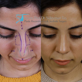 Revision Rhinoplasty before and after photo of a female patient, front view, 1 year after surgery, by Prof. Dr. Süleyman Taş, plastic surgeon in Istanbul