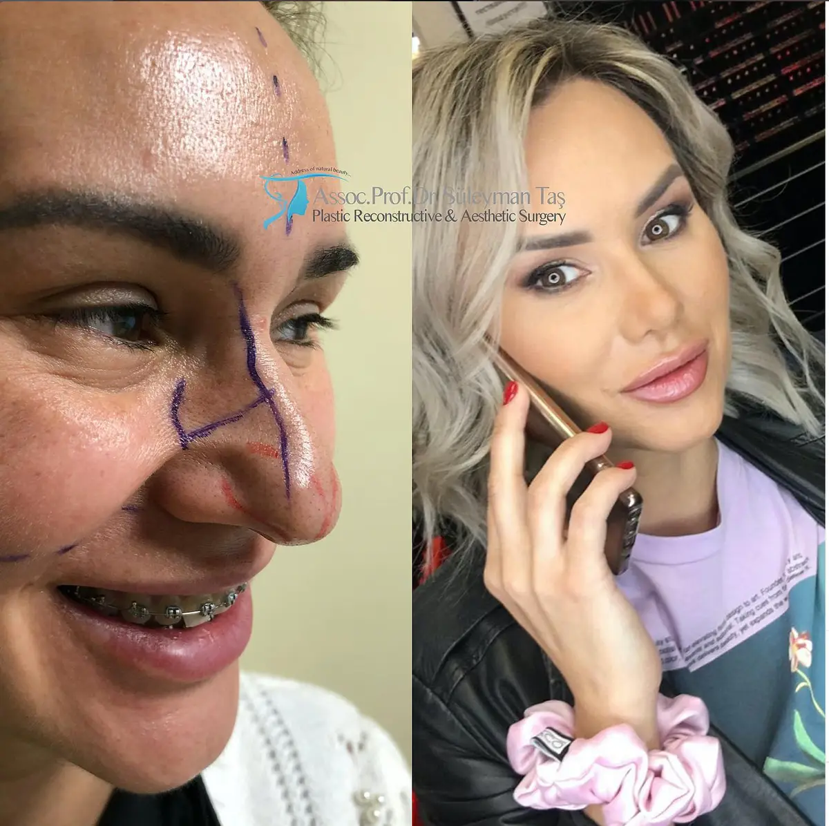 Suleyman Tas reviews – verified rhinoplasty patient review #139 (photo 1)
