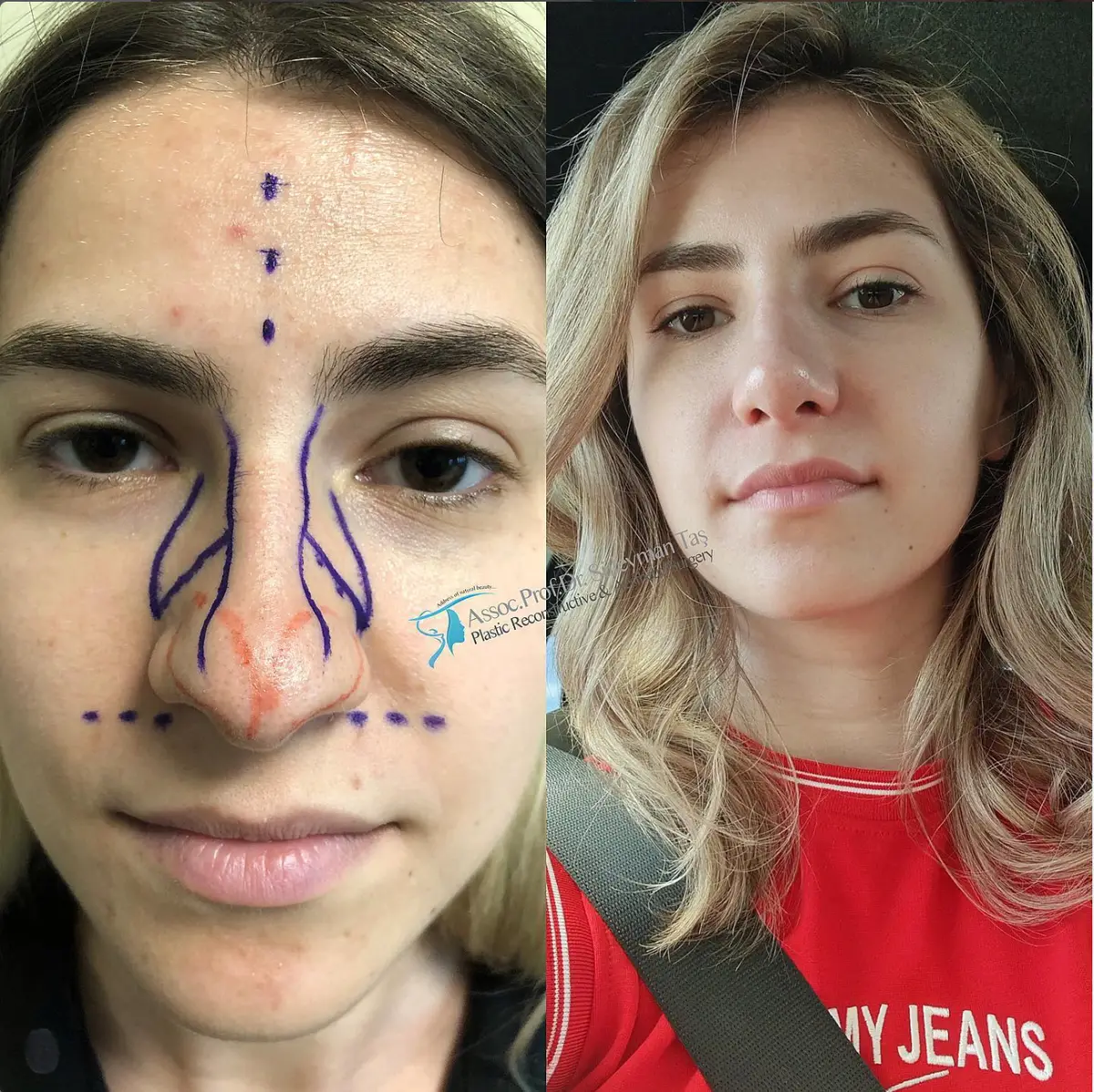 Suleyman Tas reviews – verified rhinoplasty patient review #116 (photo 1)