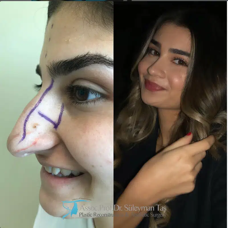 Suleyman Tas reviews – verified rhinoplasty patient review #186 (photo 2)