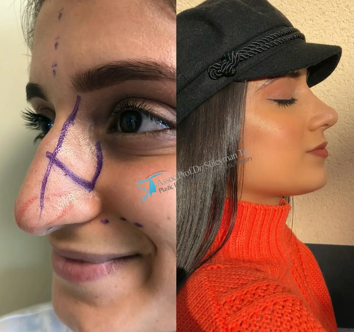 Suleyman Tas reviews – verified rhinoplasty patient review #149