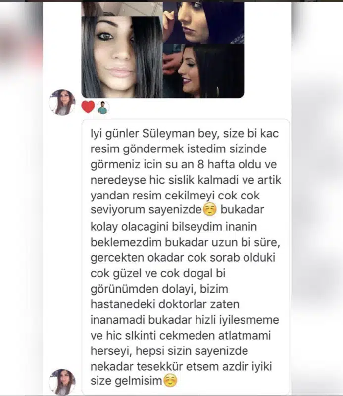 Suleyman Tas reviews – verified rhinoplasty patient review #331